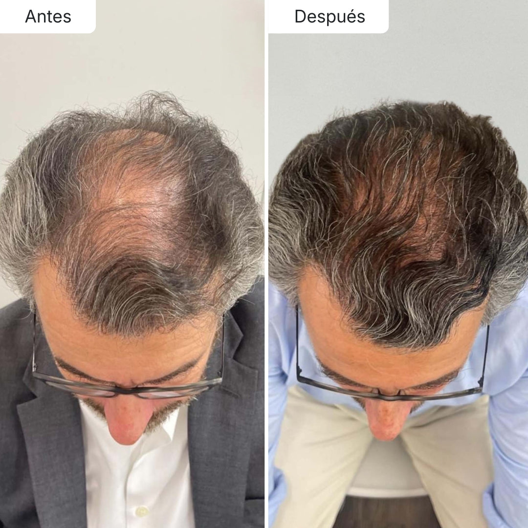 Sérum Anticaída de Doble Acción | Hair Biolabs™