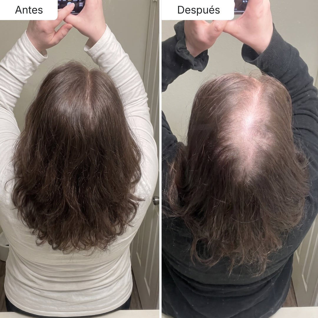 Estimula el folículo y potencia el crecimiento - Dermaroller Capilar Hair Biolabs - Hair Biolabs