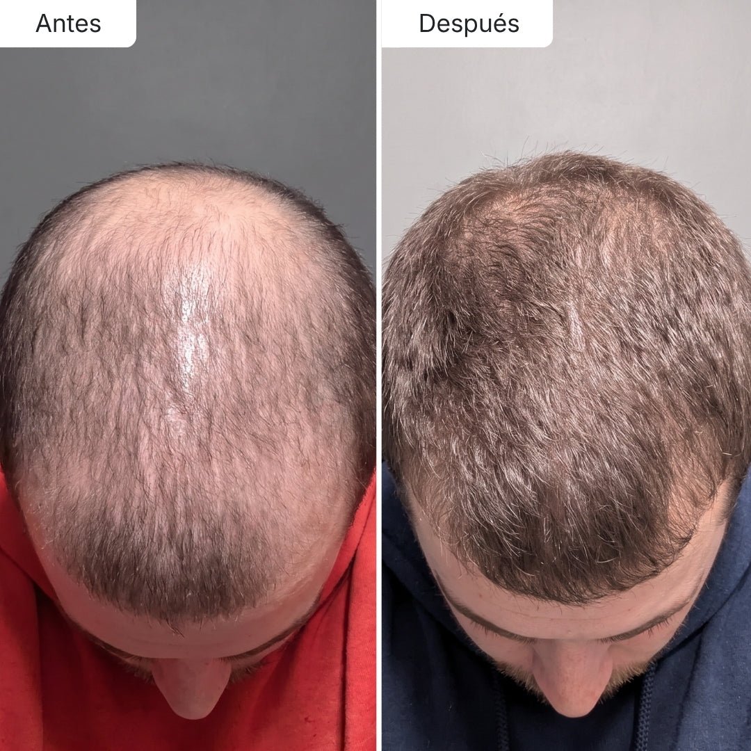 Estimula el folículo y potencia el crecimiento - Dermaroller Capilar Hair Biolabs - Hair Biolabs
