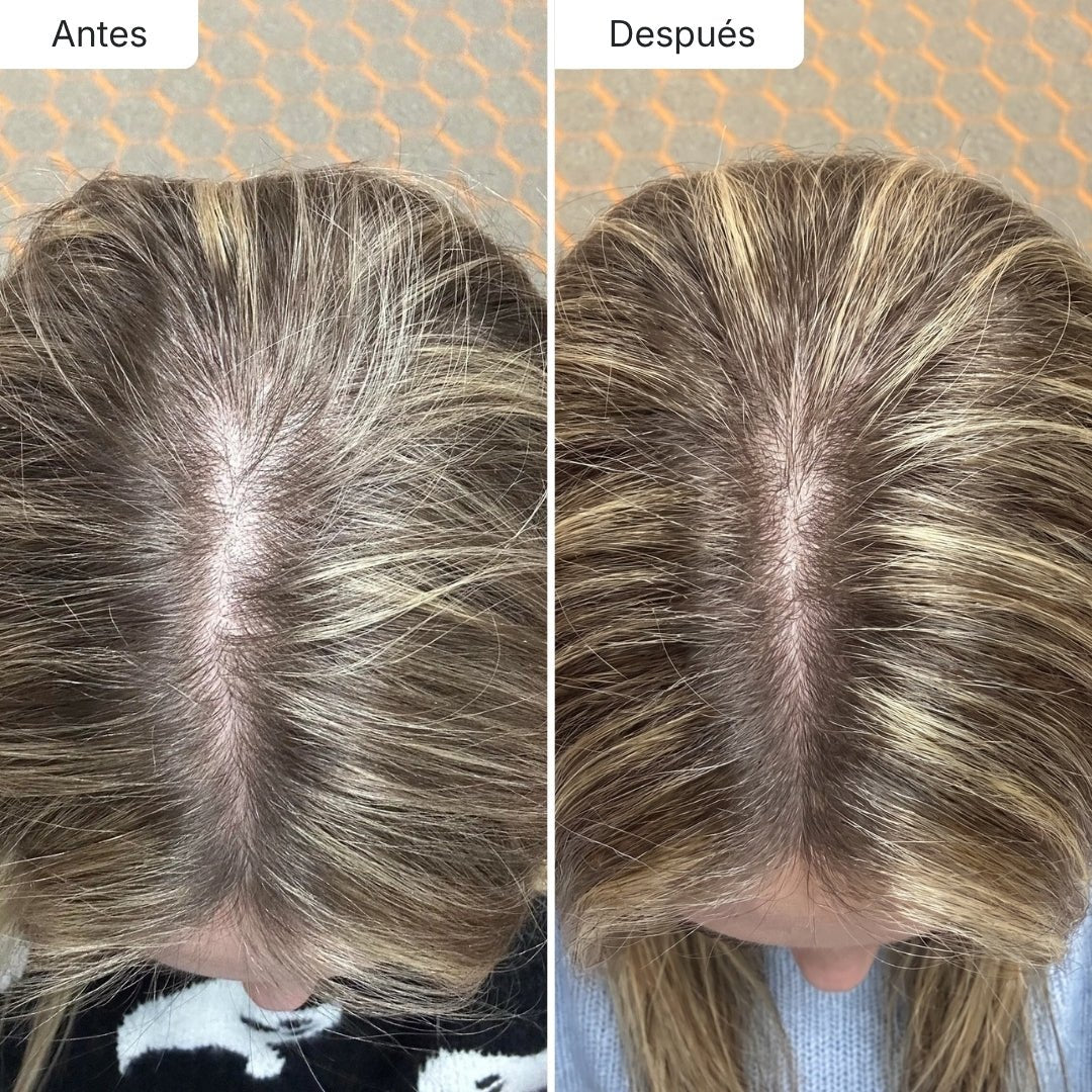 Estimula el folículo y potencia el crecimiento - Dermaroller Capilar Hair Biolabs - Hair Biolabs