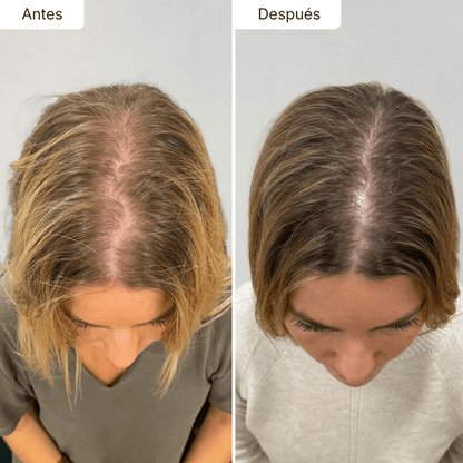Hair Biolabs REDENSIFY™ Sérum de Triple Acción - Para la Caida en 14 dias - Hair Biolabs