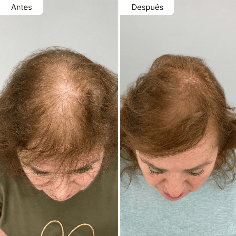 Hair Biolabs REDENSIFY™ Sérum de Triple Acción - Para la Caida en 14 dias - Hair Biolabs