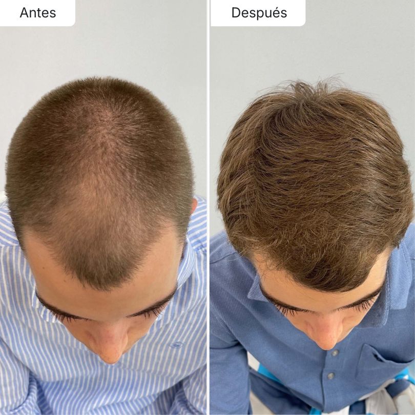 Hair Biolabs™ | Sérum Anticaída de Doble Acción - Hair Biolabs