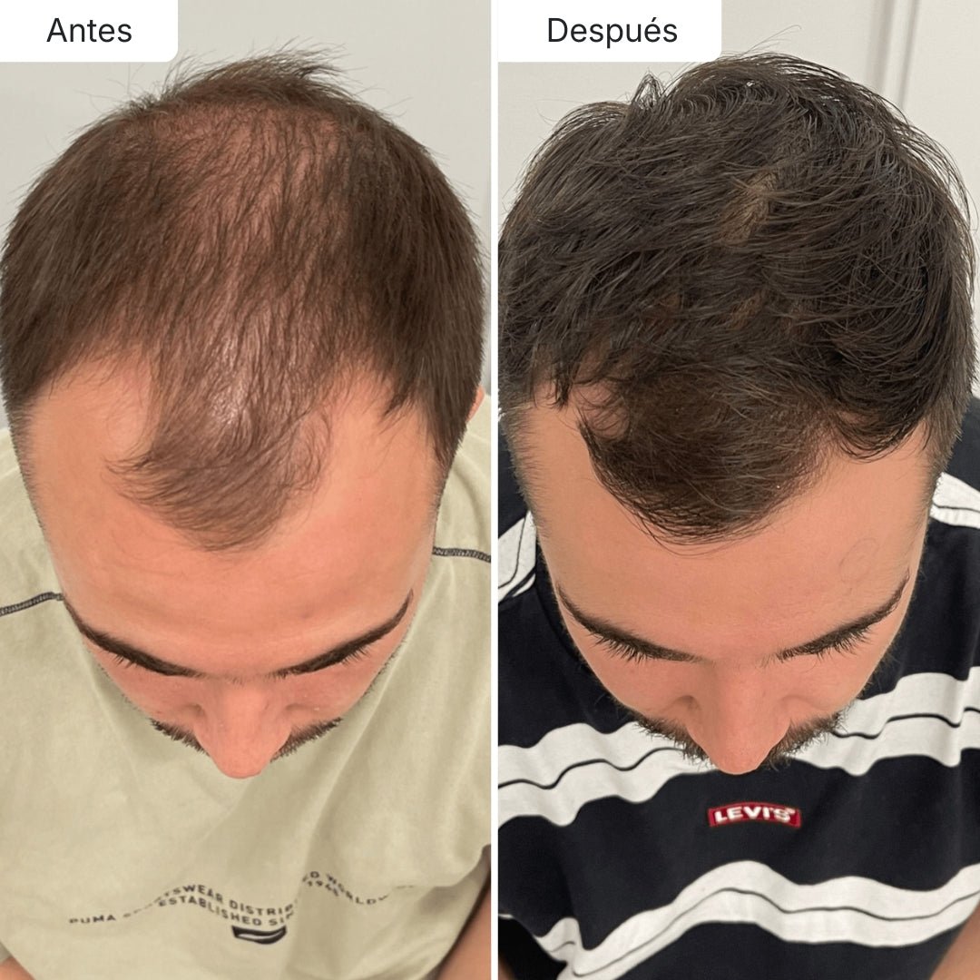 Hair Biolabs™ | Sérum Anticaída de Doble Acción - Hair Biolabs