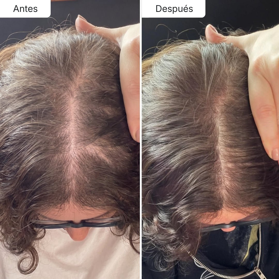 Oferta Limitada Hair Biolabs REDENSIFY™ Sérum de Triple Acción - Para la Caída en 14 dias - Hair Biolabs