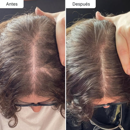 Oferta Limitada Hair Biolabs REDENSIFY™ Sérum de Triple Acción - Para la Caída en 14 dias - Hair Biolabs
