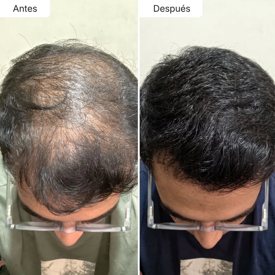 Serum Anticaída para hombres y mujeres Hair Biolabs™ - Hair Biolabs