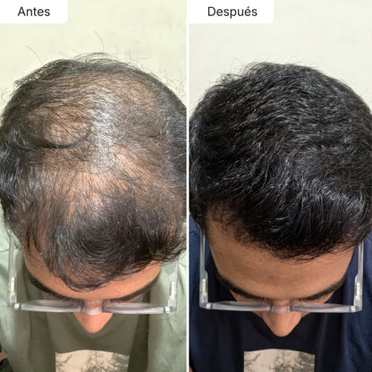 Serum Anticaída para hombres y mujeres Hair Biolabs™ - Hair Biolabs